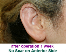 plastic-surgery-prominent-ear 